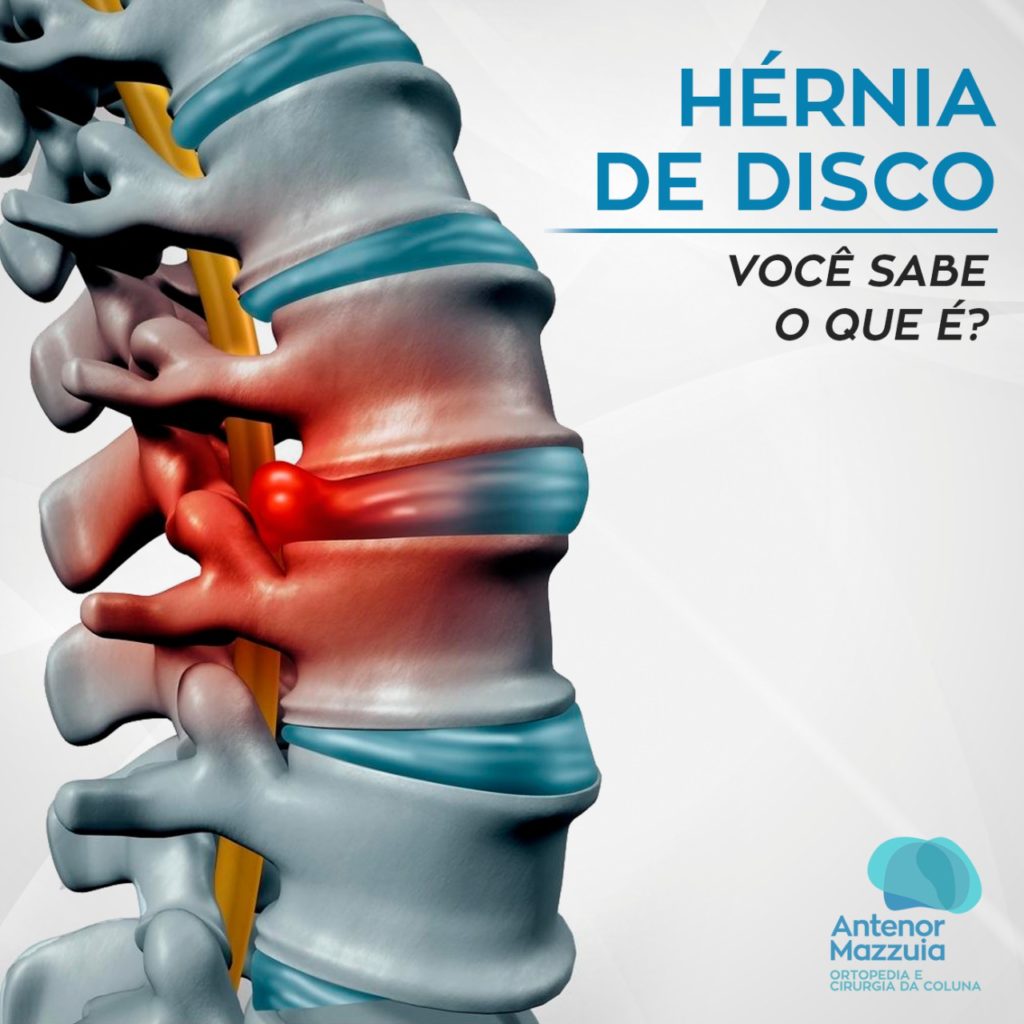 H Rnia De Disco Voc Sabe O Que Antenor Mazzuia Ortopedia E Cirurgia Da Colunaantenor