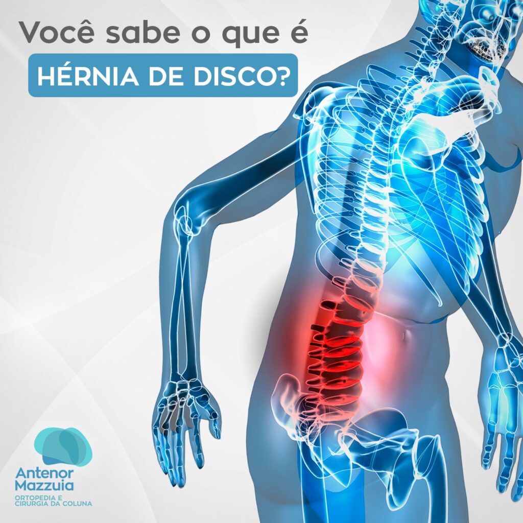 Você sabe o que é hérnia de disco? - Antenor Mazzuia Ortopedia e ...